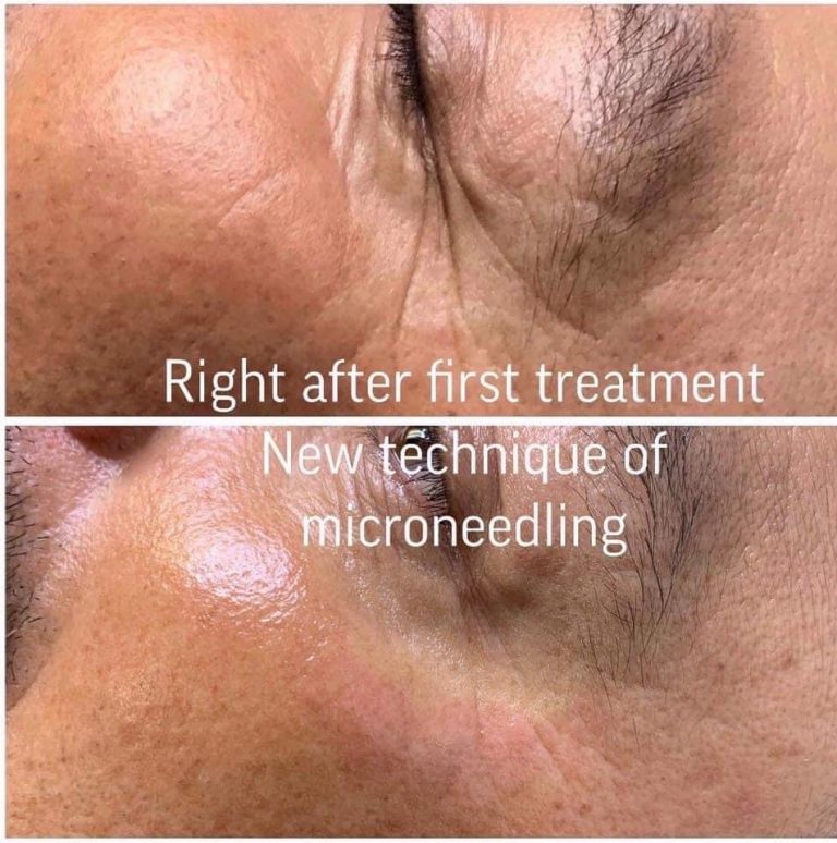 Microneedling AP Threading